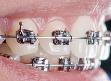 Close-up dental braces on teeth. Orthodontic Treatment. Dental care Concept. Extreme macro.
