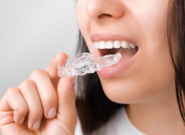 Close up of a young woman adjusting transparent aligners. Taking care of teeth. Orthodontic treatment for straightening and whitening teeth