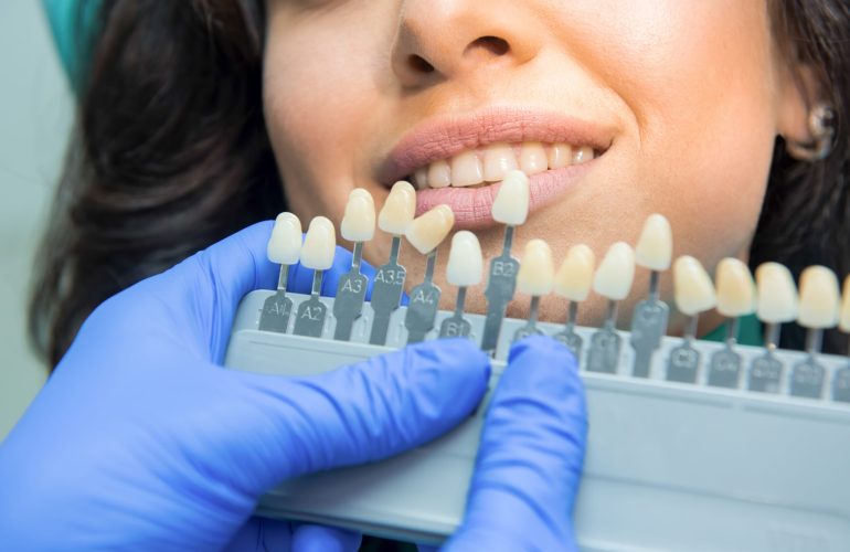 Tooth whitening chart. Smile of young woman.